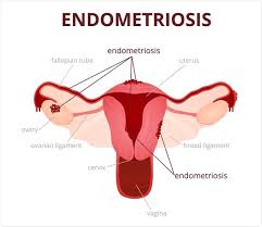 To diagnose endometriosis and other conditions that can cause pelvic pain, your doctor will ask you to describe your symptoms, including the location of your pain and when it occurs. What Is Endometriosis