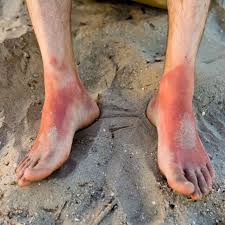 Maybe you would like to learn more about one of these? Burn Pictures First Second And Third Degree