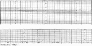 Image result for FHR Variability