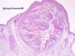 Webpathology Com A Collection Of Surgical Pathology Images