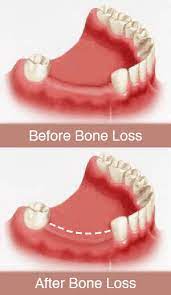 This disease can eventually affect your jawbone if not caught and treated, can lead to tooth and bone loss, and is even considered a risk factor for heart and lung disease. Periodontal Bone Regeneration Pittsburgh Dental Implants Periodontist