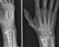 Image result for Wrist XRay