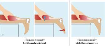 Ein direktes trauma, etwa ein tritt oder schlag auf. Achillessehnenruptur Achillessehnenriss Deutsche Gesellschaft Fur Unfallchirurgie