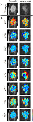 A ct scan can help doctors find cancer and show things like a tumor's shape and size. A Priori Prediction Of Tumour Response To Neoadjuvant Chemotherapy In Breast Cancer Patients Using Quantitative Ct And Machine Learning Scientific Reports