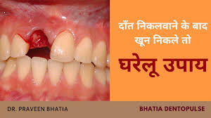 But don't worry, from start to finish, we take every precaution to ensure their health and safety throughout the procedure. Home Remedies On Blood Stopping After Tooth Extraction How To Treat Bleeding Gums At Home Youtube