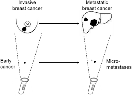Most often, metastatic breast cancer arises months or years after a person has completed treatment for early or locally advanced breast cancer. Is Invasion A Necessary Step For Metastases In Breast Cancer Springerlink