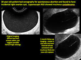 If the cyst either breaks open or causes twisting of the ovary, it may cause severe pain. Imaging The Suspected Ovarian Malignancy 14 Cases Mdedge Obgyn