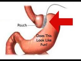 How much does lap band, gastric bypass, lap gastric sleeve, realize band surgery cost? Gastric Bypass Surgery Cost And Gastric Banding Cost Youtube