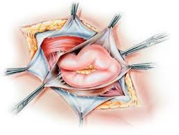A patient's health affects the time it takes to recover from hernia mesh surgery. Hernia Mesh Surgery Using Surgical Mesh For Hernia Repairs