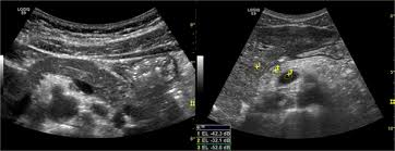 Cystic fibrosis | care guidelines for nutrition management. Plos One Ultrasound Echo Intensity Predicts Severe Pancreatic Affection In Cystic Fibrosis Patients