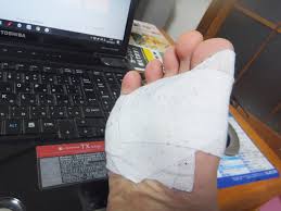 足裏のウイルス性イボとの闘い レーザー治療をする Toita Blog