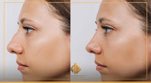 أهم تعليمات العناية بالانف اللحمي بعد التجميل