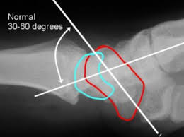 Image result for Scapholunate Dislocation