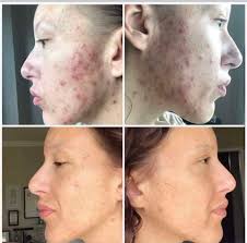 Dark Spots? Pigmentation? Not Anymore! Try This Magic Night Cloves Oil 👇💬