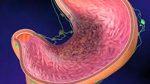 Le cancer de l'estomac est une forme de cancer qui se développe à partir des cellules de la muqueuse de l'estomac. Le Cancer De L Estomac Service De Chirurgie Viscerale Chuv