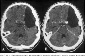 Approfondiamo le caratteristiche e le tipologie dell'aneurisma. Pdf Aneurisma Cerebral E Cisto De Aracnoide A Proposito De Caso Com Hemorragia Intracistica Semantic Scholar