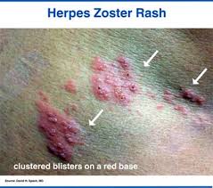 Image result for skin rash acute hiv infection