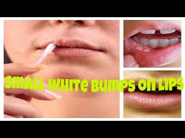 How To Remove Small White Bumps On Lips Small White Bumps On Face Youtube Clear Skin Tips Lips White Bumps On Face