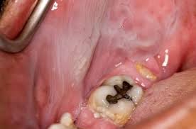Image result for Leukoedema