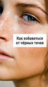 эффективные маски для лица от прыщей и черных точек Kak Izbavitsya Ot Chyornyh Tochek Chistoe Lico Detoks Kozhi Hudoe Lico