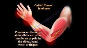 Cubital Tunnel Syndrome Ulnar Nerve Entrapment Everything You Need To Know Dr Nabil Ebraheim Youtube