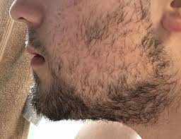 17 Years Old Growing My Patchy Beard For A Whole Year As A Challenge This Is At A Week And A Half Of Growth Looks Prett Patchy Beard Beard How To