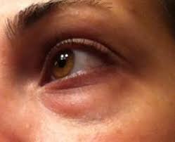 Goz Alti Torbalari Mi Dogal Yollarla Kurtulun Sagliga Bir Adim Under Eye Wrinkles Homemade Beauty Care Eye Bags