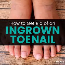 ingrown toenail removal and remes