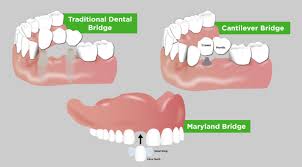 They are used when your natural teeth surround a missing tooth or gap on both sides. Dental Bridges Yonkers Partial Bridges Yonkers