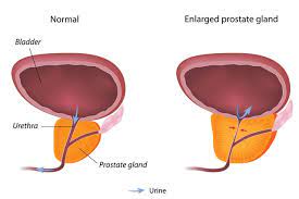 In other words, most prostate cancers remain perpetually latent and, for all intents and purposes, are completely harmless. Benign Prostate Enlargement Nhs