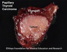 The majority of patients with papillary thyroid cancer do well after the treatment which includes surgery and often radioactive iodine therapy. Papillary Thyroid Carcinoma Braf Immunopositivity Mayo Clinic Proceedings