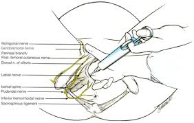Image result for Pudendal Block