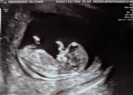 Baby gender when can you tell? Gender Guesses 12 Week Ultrasound Boy Or Girl Babycenter