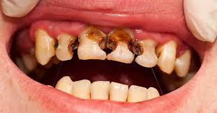 Review botol susu bayi philips avent vs dr. Penyebab Terjadi Baby Bottle Tooth Decay