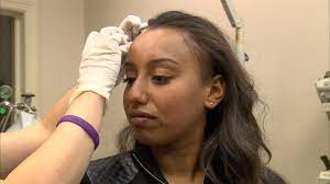 Triamcinolone acetonide is a type of corticosteroid which is different than anabolic steroids (a common source of confusion and fear for the patient). New Treatment May Regrow And Thicken Hair Without Surgery Video Abc News