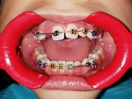 The answer is that the process is fairly involved depending on how much correction is needed to reach the desired result. Clear Ceramic Braces Near Me For Less Noticeable Treatment Of Crooked Teeth Pixelhub Me