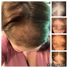 Progress More In The Comments Femalehairloss