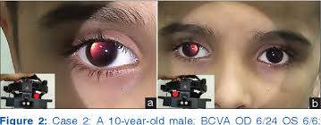 Image result for Red Reflex