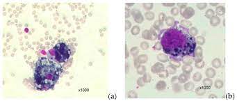Cells Free Full Text Bone Marrow Involvement In Melanoma Potentials For Detection Of Disseminated Tumor Cells And Characterization Of Their Subsets By Flow Cytometry Html