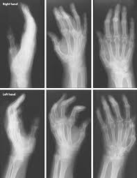 Image result for XRay Changes in Rheumatic Conditions