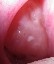Learn more about the causes and treatment of bumps in the back of the throat here. White Spots In Throat Strep Throat Tonsil Stones