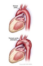 thoracic aortic aneurysm society for vascular surgery