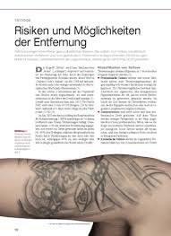 Search the world's information, including webpages, images, videos and more. Tattoos Risiken Und Moglichkeiten Der Entfernung