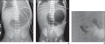 Image result for Midgut Volvulus