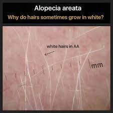 Hair regrowth following alopecia areata may be associated with poliosis. Pin On Alopecia