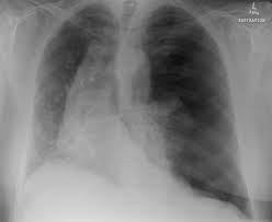 Image result for Open Pneumothorax