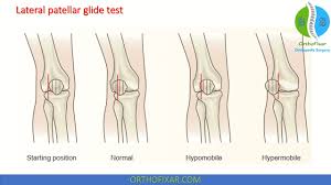 Image result for Patella Mobility Test