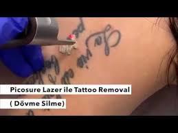 Dovme Silme Picosure Lazer Ile Dovme Silme Youtube Dovme Youtube Adlar
