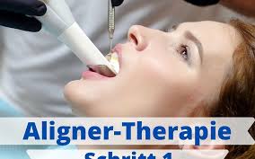 Die aligner therapie korrigiert unsichtbar und zahnärztlich begleitet zahnfehlstellungen. Aligner Therapie Ablauf Solo Zahnarztpraxis Leipzig