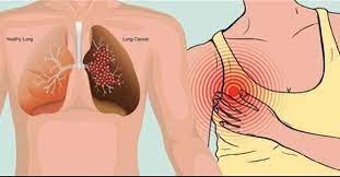 Lung cancer is a type of cancer that begins in the lungs. What Is The Earliest And Lightest Symptom Of Lung Cancer Quora